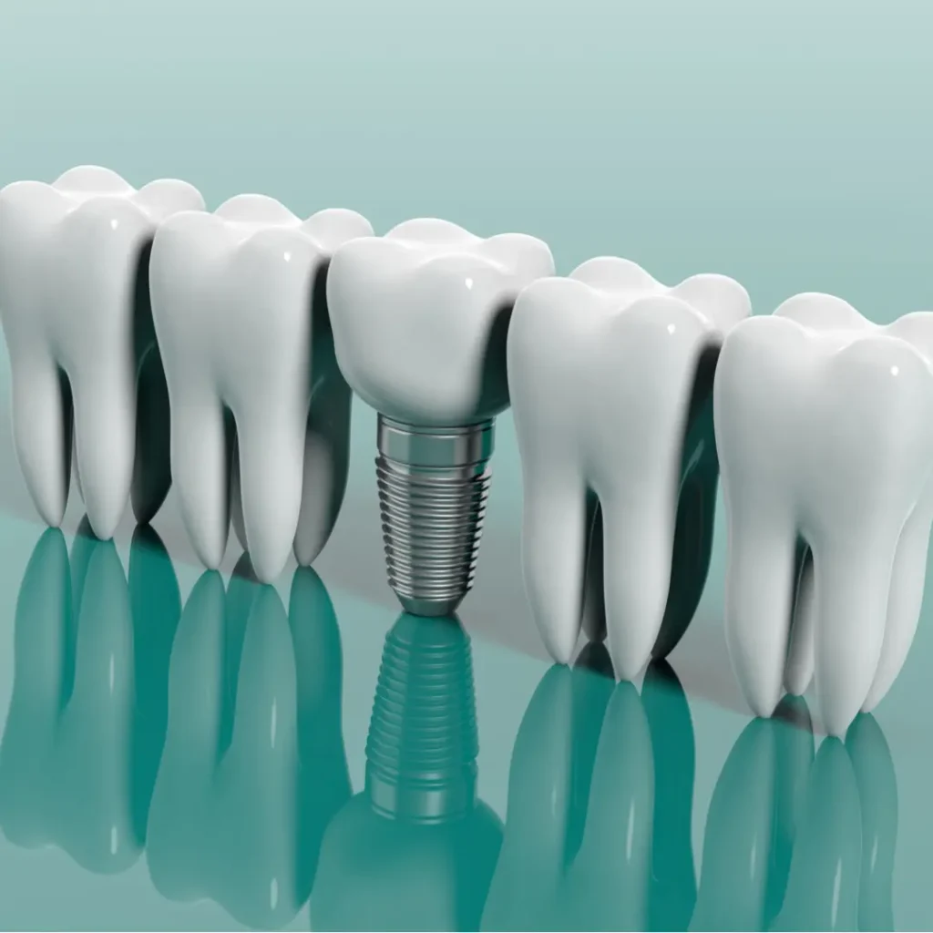 Rappresentazione di un impianto dentale tra denti naturali, simbolo di implantologia moderna