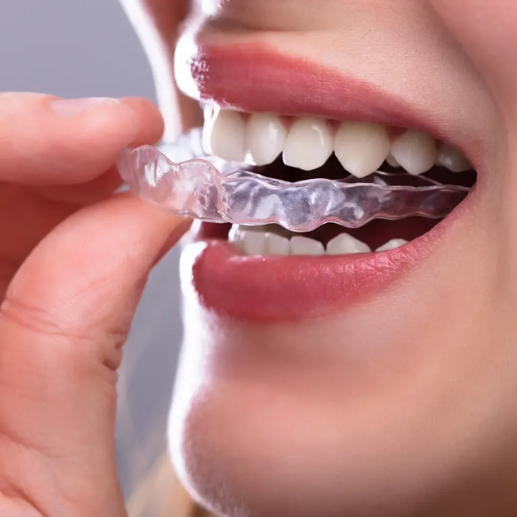 Donna applica un bite dentale trasparente, utilizzato per trattare il bruxismo notturno