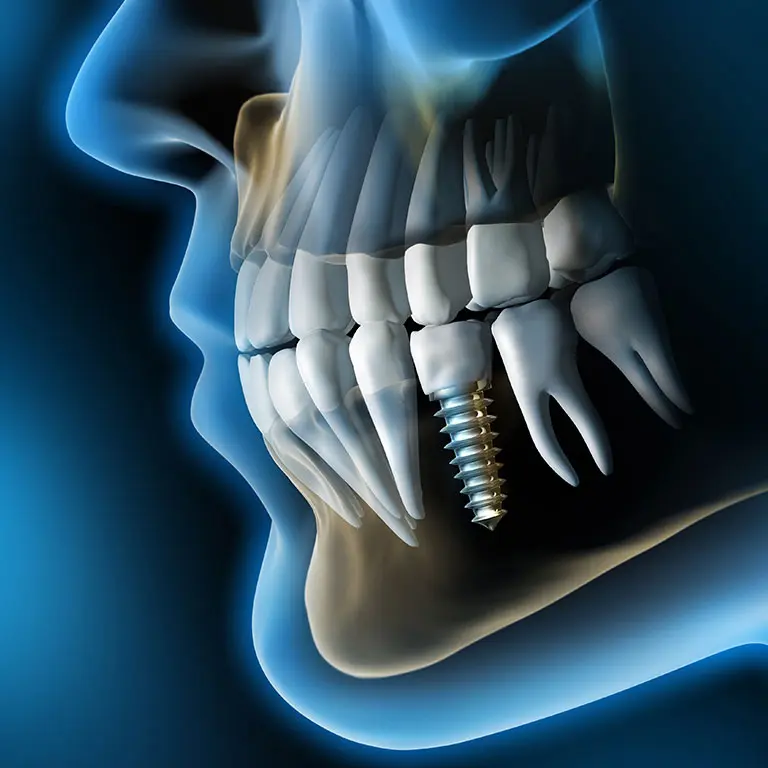 Radiografia del cranio con impianto dentale, esempio di chirurgia orale avanzata
