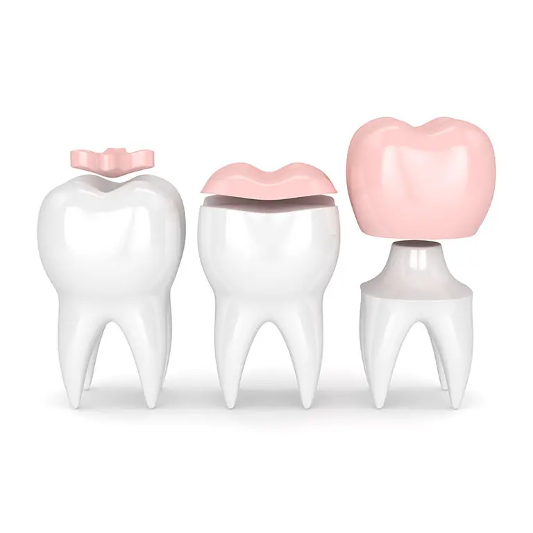 Processo delle corone dentali CAD/CAM: riparazione e protezione dei denti danneggiati