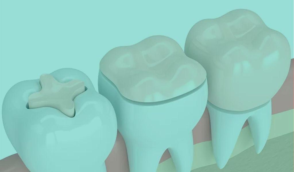 Rappresentazione grafica di un intarsio dentale, soluzione duratura per ripristinare un dente danneggiato
