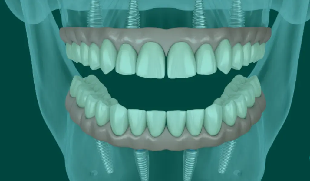 Modello 3D della tecnica implantare All On Four presso lo Studio Odontoiatrico Del Malvò a Torino