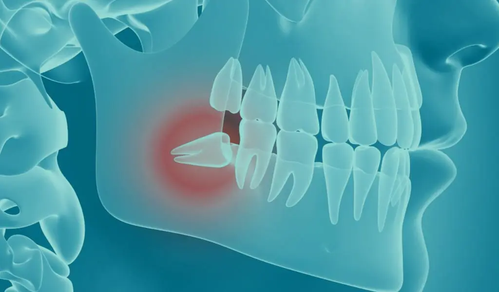 Radiografia 3D mostra un dente del giudizio incluso, evidenziato da un'area arrossata per indicare il dolore
