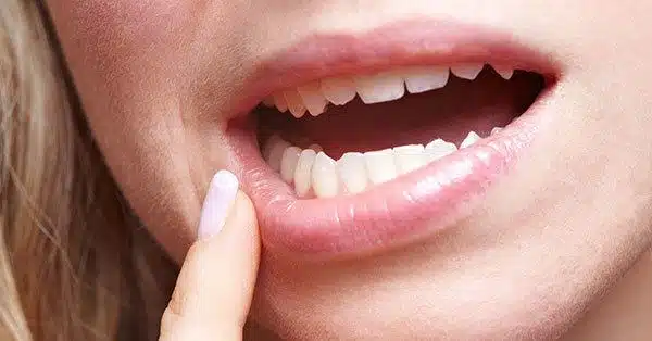 Primo piano di una donna che indica un dente, segno di sensibilità dentale o dolore gengivale.