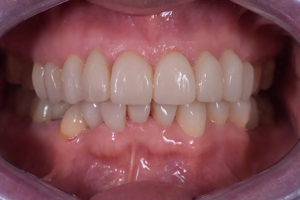 Risultato finale: denti ricostruiti e migliorati dopo il trattamento del bruxismo