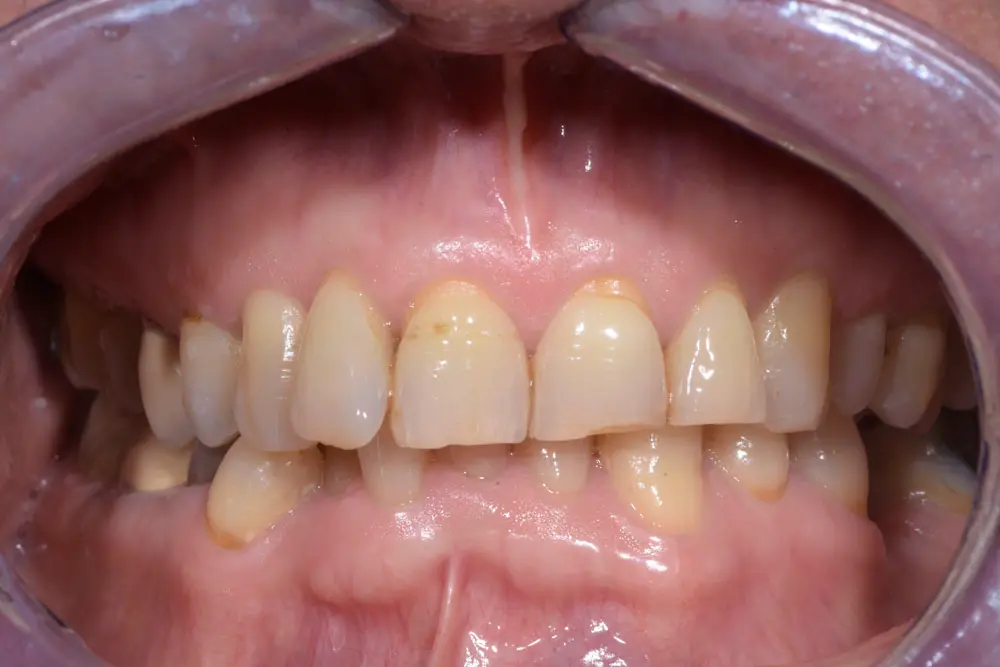Denti consumati e ingialliti a causa del bruxismo prima del trattamento