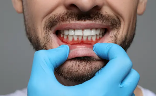 dentista-torino-enrico-del-malvo-gengivite-1